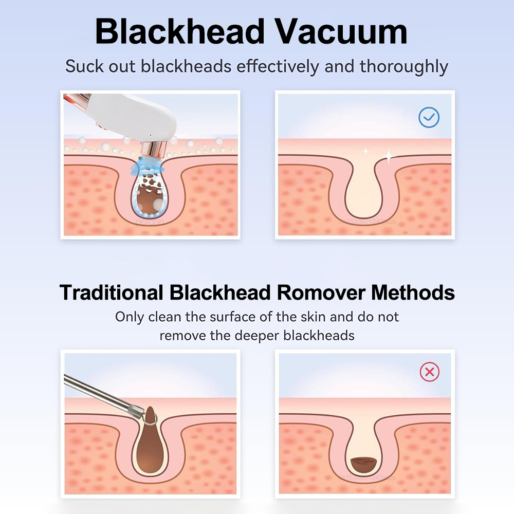 Electric Blackhead Remover Vac - Pore Vacuum review and price