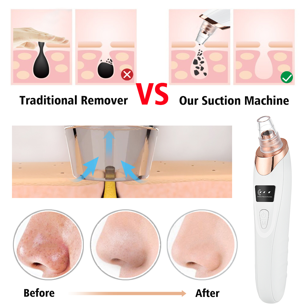 Blackhead Remover Vacuum Pore  - Pore Vacuum review and price